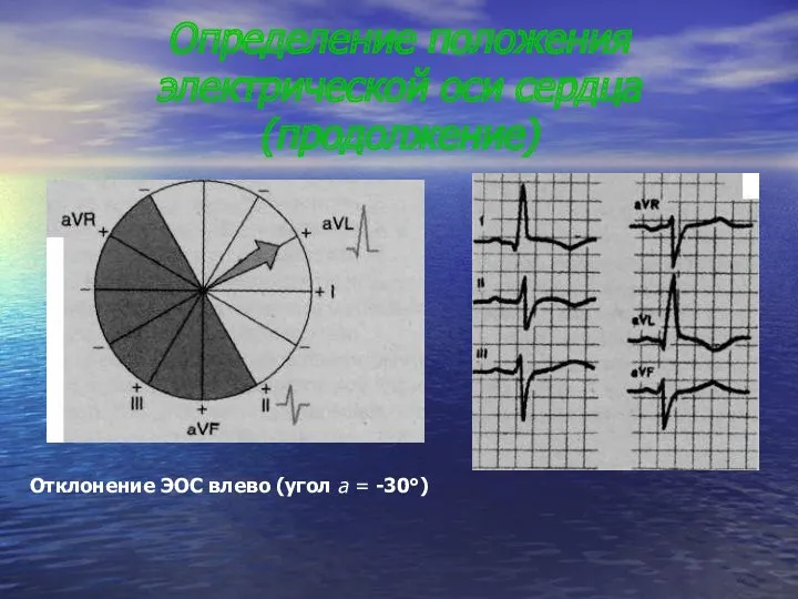 Определение положения электрической оси сердца(продолжение) Отклонение ЭОС влево (угол а = -30°)