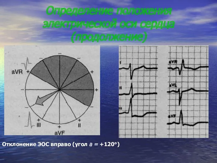 Определение положения электрической оси сердца(продолжение) Отклонение ЭОС вправо (угол а = +120°)