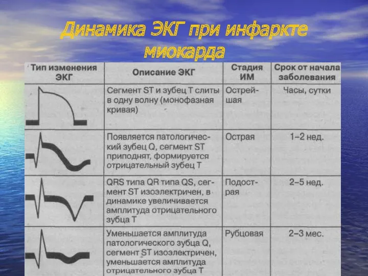 Динамика ЭКГ при инфаркте миокарда