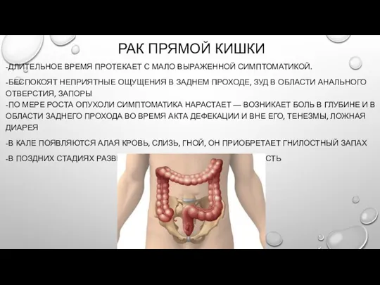 РАК ПРЯМОЙ КИШКИ -ДЛИТЕЛЬНОЕ ВРЕМЯ ПРОТЕКАЕТ С МАЛО ВЫРАЖЕННОЙ СИМПТОМАТИКОЙ.