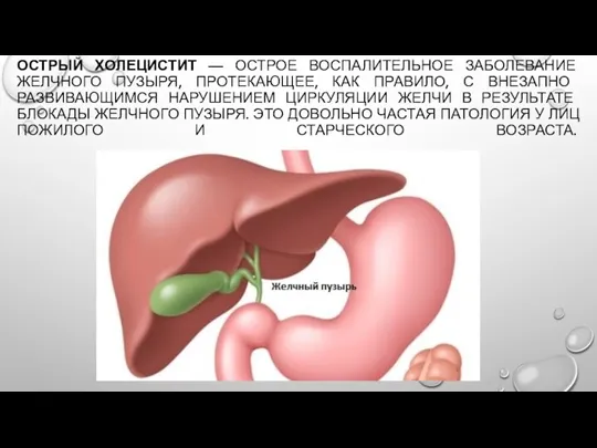 ОСТРЫЙ ХОЛЕЦИСТИТ — ОСТРОЕ ВОСПАЛИТЕЛЬНОЕ ЗАБОЛЕВАНИЕ ЖЕЛЧ­НОГО ПУЗЫРЯ, ПРОТЕКАЮЩЕЕ, КАК