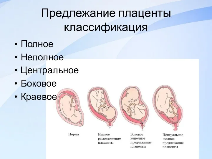 Предлежание плаценты классификация Полное Неполное Центральное Боковое Краевое