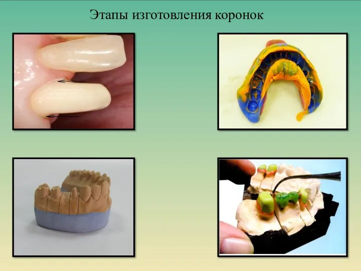 Этапы изготовления коронок