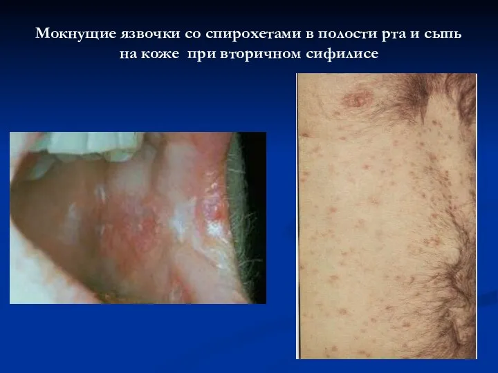 Мокнущие язвочки со спирохетами в полости рта и сыпь на коже при вторичном сифилисе
