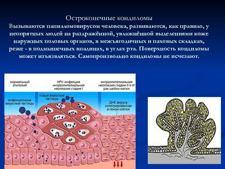 Остроконечные кондиломы Вызываются папилломовирусом человека, развиваются, как правило, у неопрятных