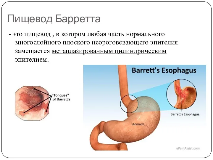 Пищевод Барретта - это пищевод , в котором любая часть