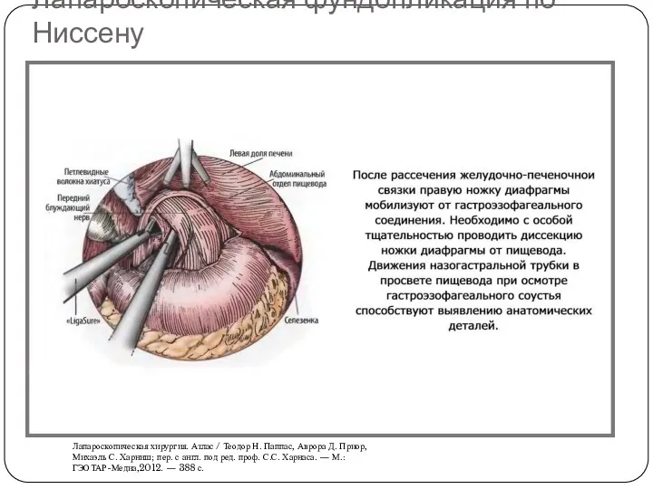 Лапароскопическая фундопликация по Ниссену Лапароскопическая хирургия. Атлас / Теодор Н.