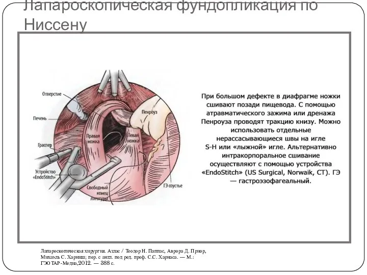 Лапароскопическая фундопликация по Ниссену Лапароскопическая хирургия. Атлас / Теодор Н.