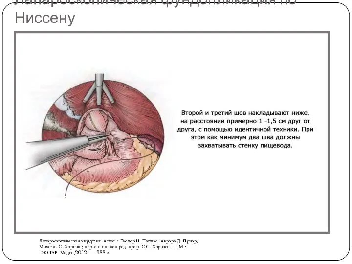 Лапароскопическая фундопликация по Ниссену Лапароскопическая хирургия. Атлас / Теодор Н.