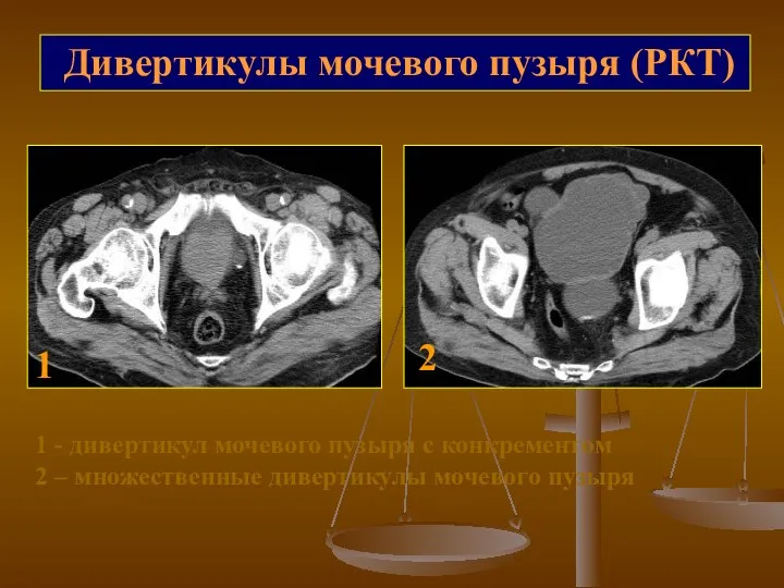 Дивертикулы мочевого пузыря (РКТ) 1 2 1 - дивертикул мочевого