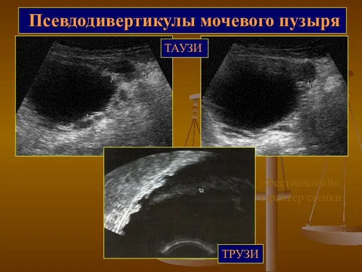 Псевдодивертикулы мочевого пузыря «Фестончатый» характер стенки ТАУЗИ ТРУЗИ