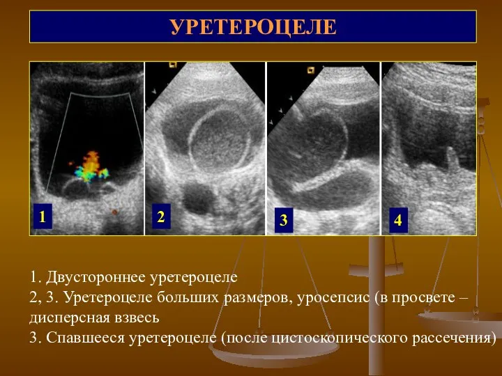 УРЕТЕРОЦЕЛЕ 1 2 3 4 1. Двустороннее уретероцеле 2, 3.