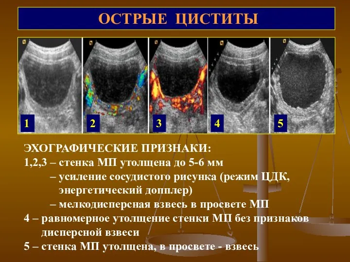 ОСТРЫЕ ЦИСТИТЫ ЭХОГРАФИЧЕСКИЕ ПРИЗНАКИ: 1,2,3 – стенка МП утолщена до