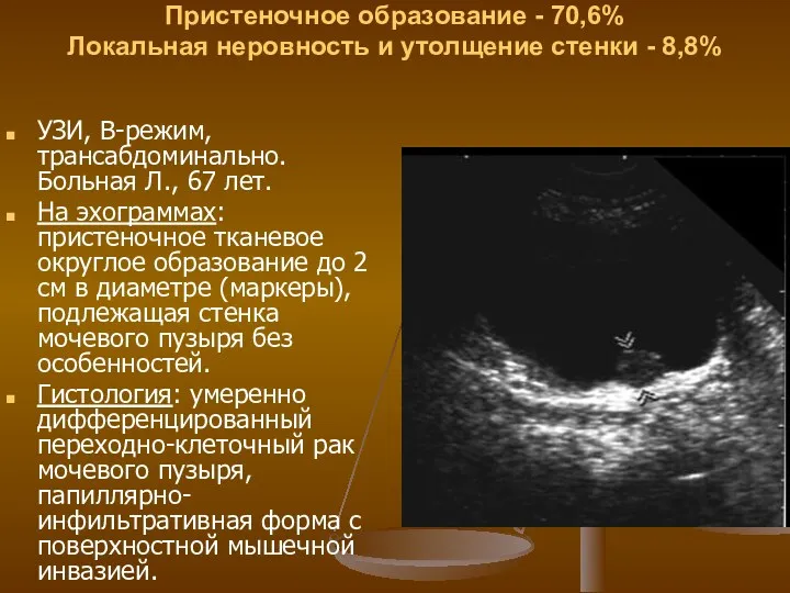 УЗ-симптомы: Пристеночное образование - 70,6% Локальная неровность и утолщение стенки
