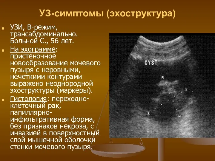 УЗ-симптомы (эхоструктура) УЗИ, В-режим, трансабдоминально. Больной С., 56 лет. На