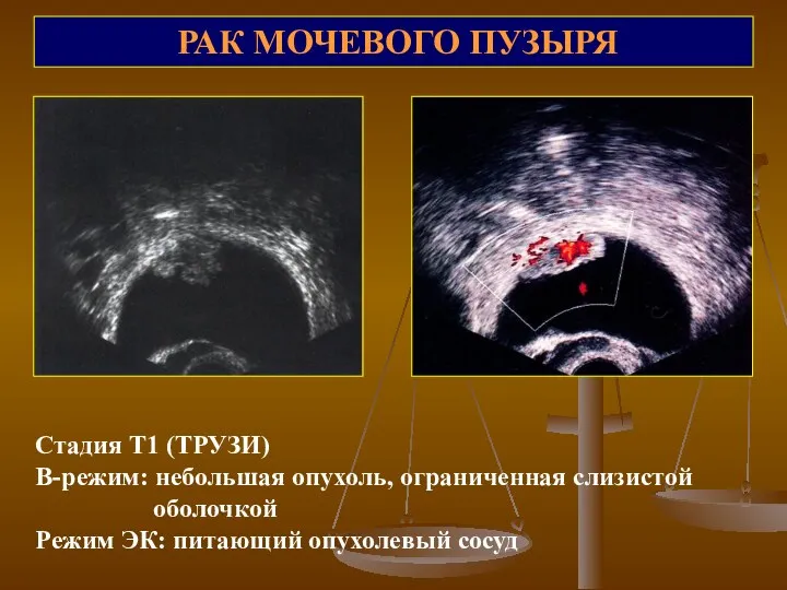 РАК МОЧЕВОГО ПУЗЫРЯ Стадия Т1 (ТРУЗИ) В-режим: небольшая опухоль, ограниченная