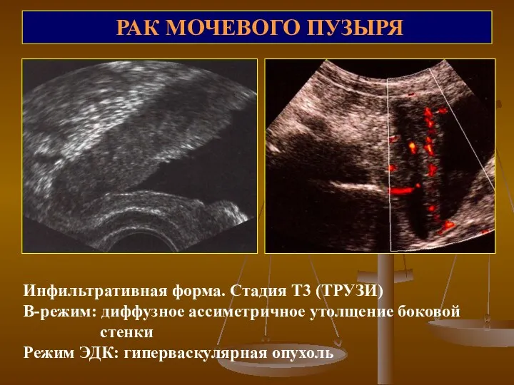 РАК МОЧЕВОГО ПУЗЫРЯ Инфильтративная форма. Стадия Т3 (ТРУЗИ) В-режим: диффузное