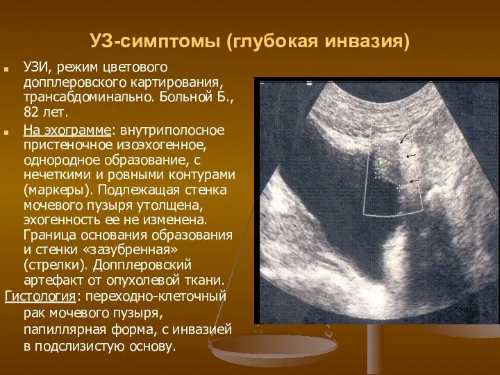 УЗ-симптомы (глубокая инвазия) УЗИ, режим цветового допплеровского картирования, трансабдоминально. Больной