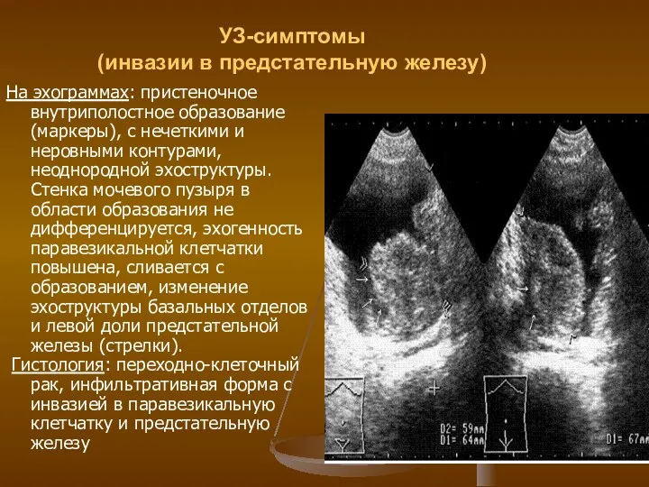 УЗ-симптомы (инвазии в предстательную железу) На эхограммах: пристеночное внутриполостное образование