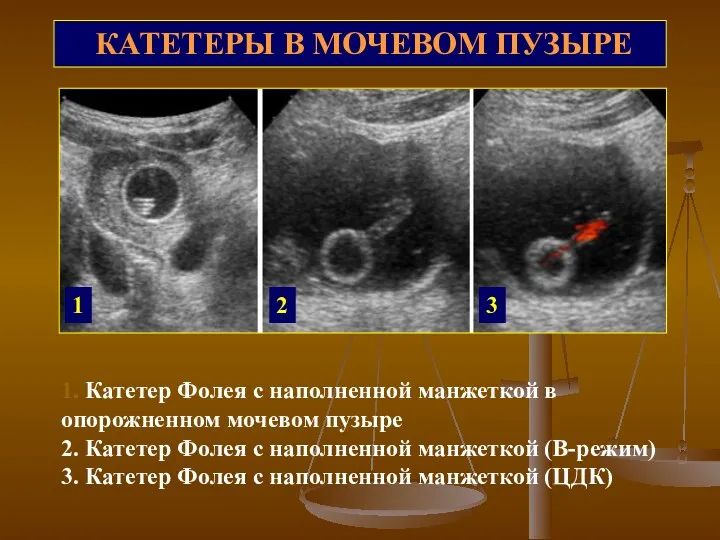 КАТЕТЕРЫ В МОЧЕВОМ ПУЗЫРЕ 1. Катетер Фолея с наполненной манжеткой