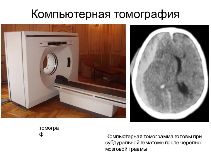 Компьютерная томография Компьютерная томограмма головы при субдуральной гематоме после черепно-мозговой травмы томограф