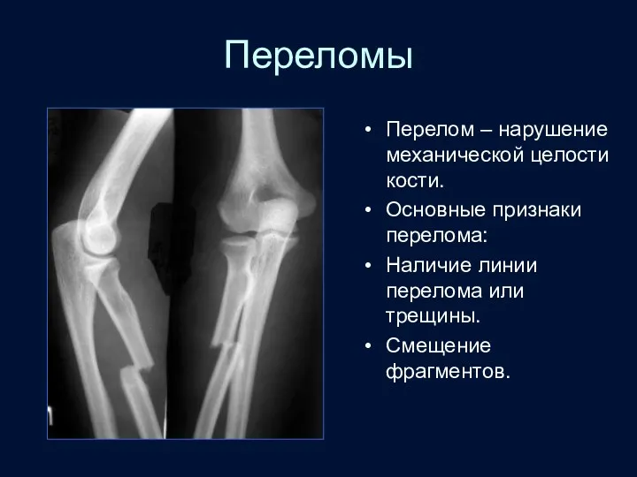 Переломы Перелом – нарушение механической целости кости. Основные признаки перелома: