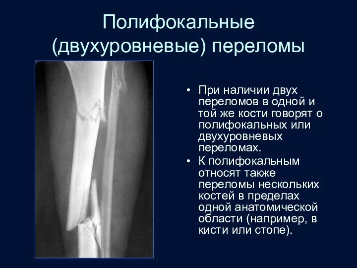 Полифокальные (двухуровневые) переломы При наличии двух переломов в одной и