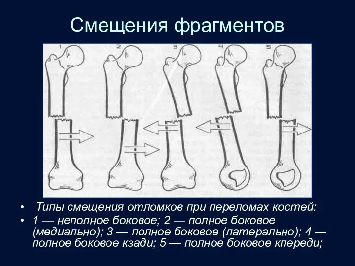 Смещения фрагментов Типы смещения отломков при переломах костей: 1 —