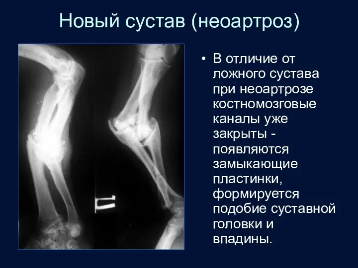 Новый сустав (неоартроз) В отличие от ложного сустава при неоартрозе