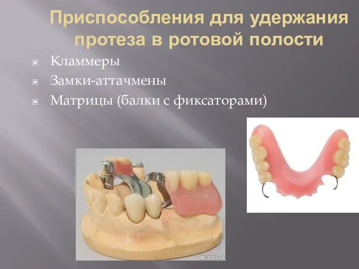 Приспособления для удержания протеза в ротовой полости Кламмеры Замки-аттачмены Матрицы (балки с фиксаторами)