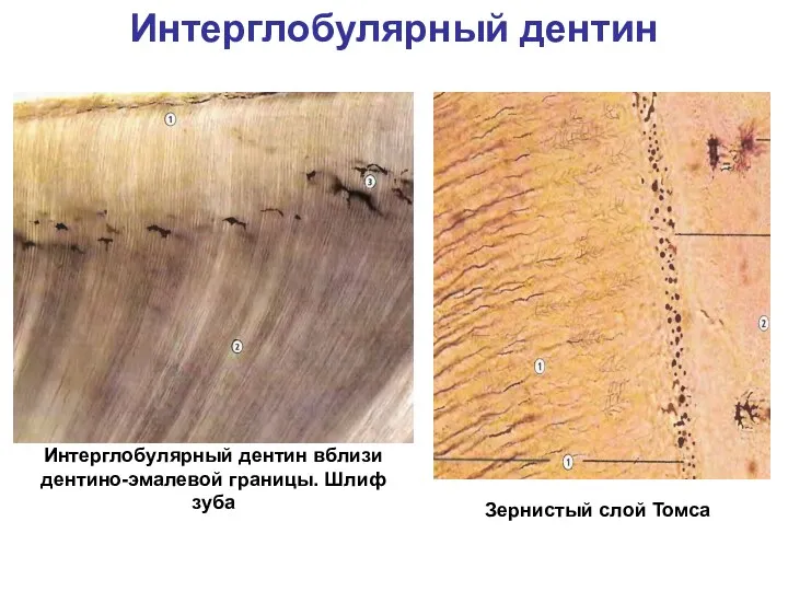 Интерглобулярный дентин Интерглобулярный дентин вблизи дентино-эмалевой границы. Шлиф зуба Зернистый слой Томса