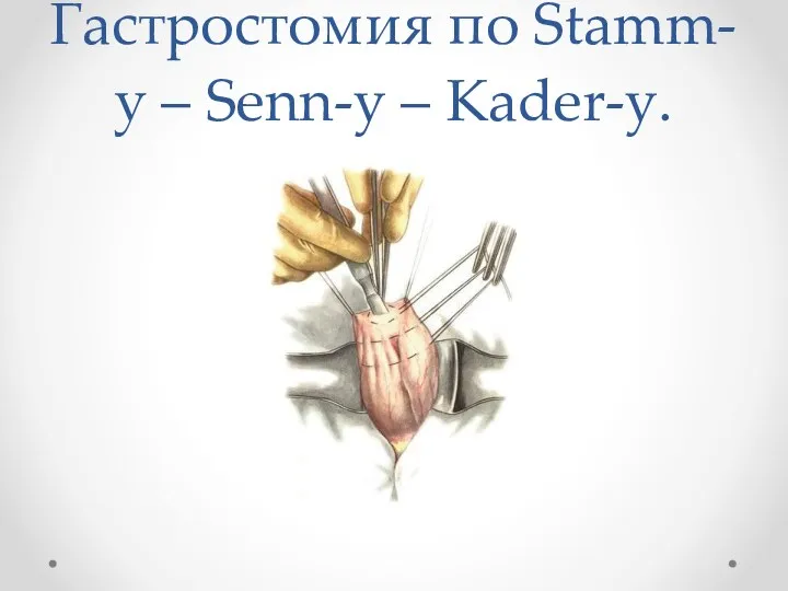 Гастростомия по Stamm-у – Senn-y – Kader-y.