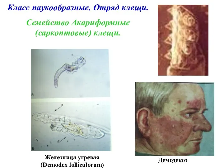 Класс паукообразные. Отряд клещи. Семейство Акариформные (саркоптовые) клещи. Демодекоз Железница угревая (Demodex folliculorum)