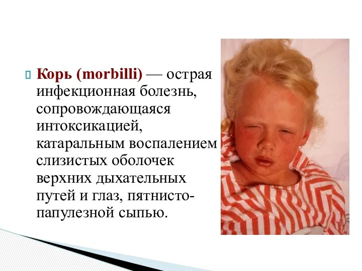 Корь (morbilli) — острая инфекционная болезнь, сопровождающаяся интоксикацией, катаральным воспалением