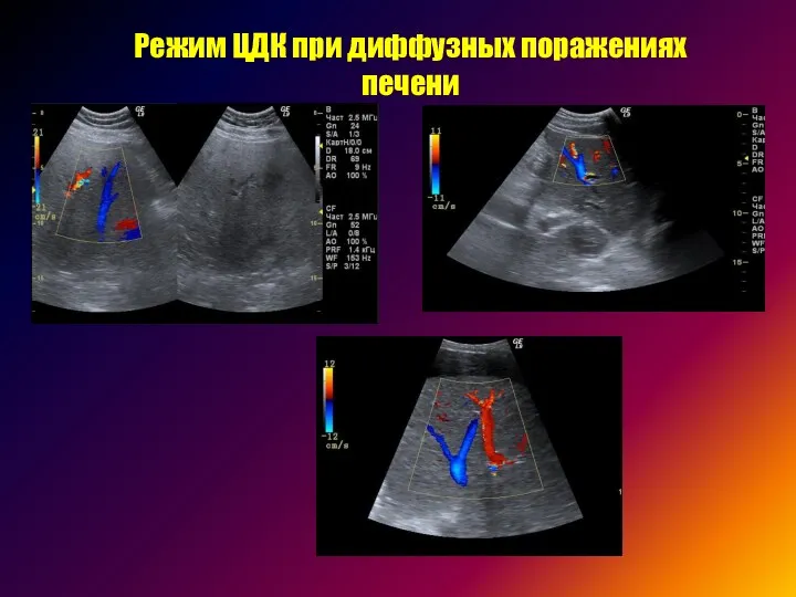 Режим ЦДК при диффузных поражениях печени