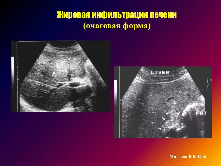 Жировая инфильтрация печени (очаговая форма) Митьков В.В.,1996