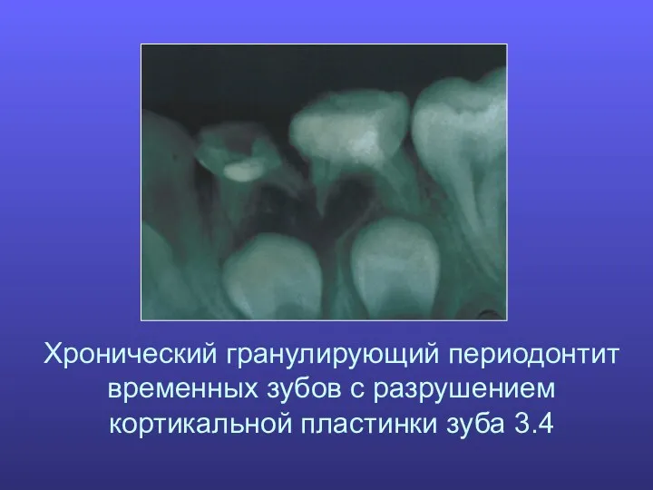 Хронический гранулирующий периодонтит временных зубов с разрушением кортикальной пластинки зуба 3.4