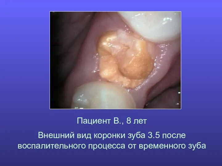Пациент В., 8 лет Внешний вид коронки зуба 3.5 после воспалительного процесса от временного зуба