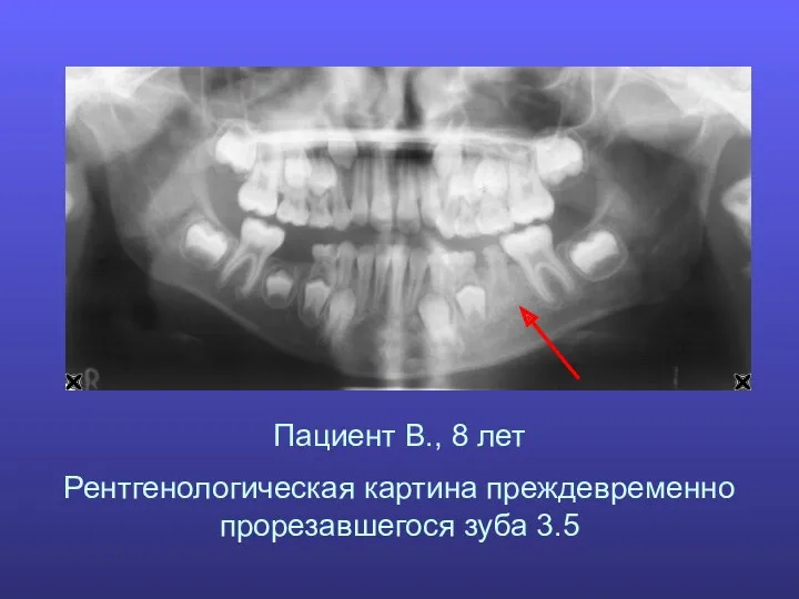 Пациент В., 8 лет Рентгенологическая картина преждевременно прорезавшегося зуба 3.5