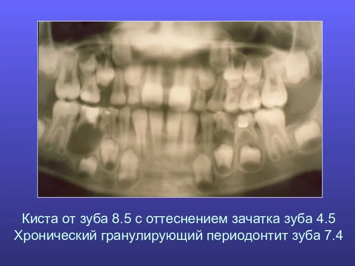 Киста от зуба 8.5 с оттеснением зачатка зуба 4.5 Хронический гранулирующий периодонтит зуба 7.4
