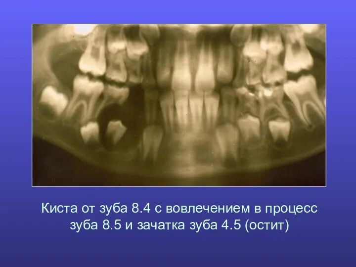 Киста от зуба 8.4 с вовлечением в процесс зуба 8.5 и зачатка зуба 4.5 (остит)