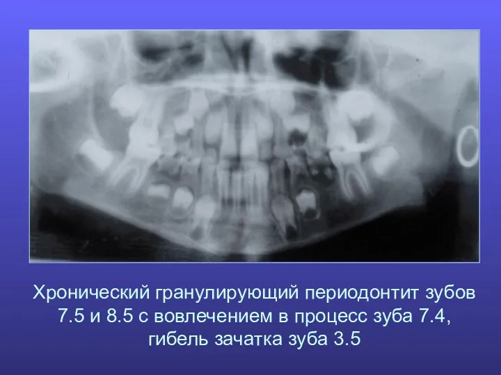Хронический гранулирующий периодонтит зубов 7.5 и 8.5 с вовлечением в