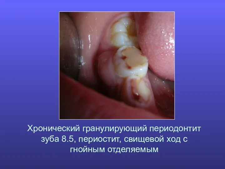 Хронический гранулирующий периодонтит зуба 8.5, периостит, свищевой ход с гнойным отделяемым