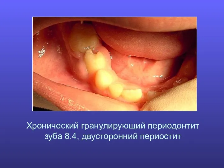 Хронический гранулирующий периодонтит зуба 8.4, двусторонний периостит
