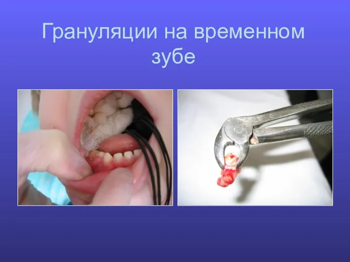 Грануляции на временном зубе