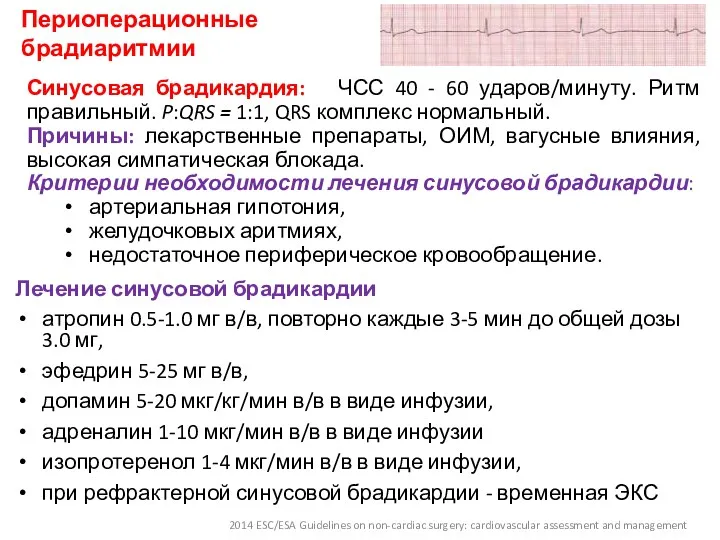 Периоперационные брадиаритмии Лечение синусовой брадикардии атропин 0.5-1.0 мг в/в, повторно