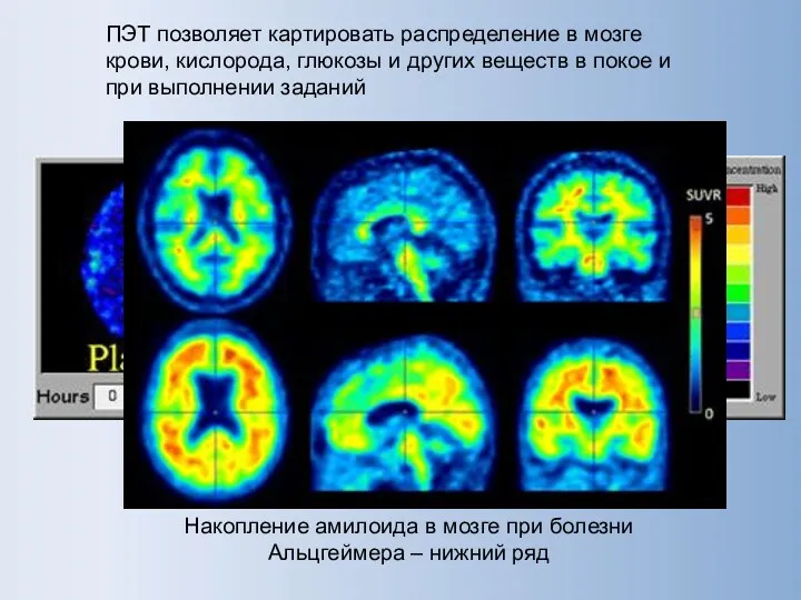 ПЭТ позволяет картировать распределение в мозге крови, кислорода, глюкозы и