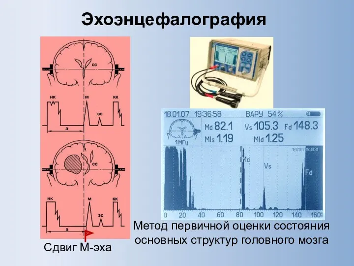 Метод первичной оценки состояния основных структур головного мозга Эхоэнцефалография Сдвиг М-эха