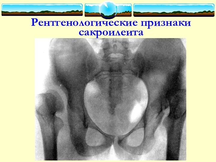 Рентгенологические признаки сакроилеита