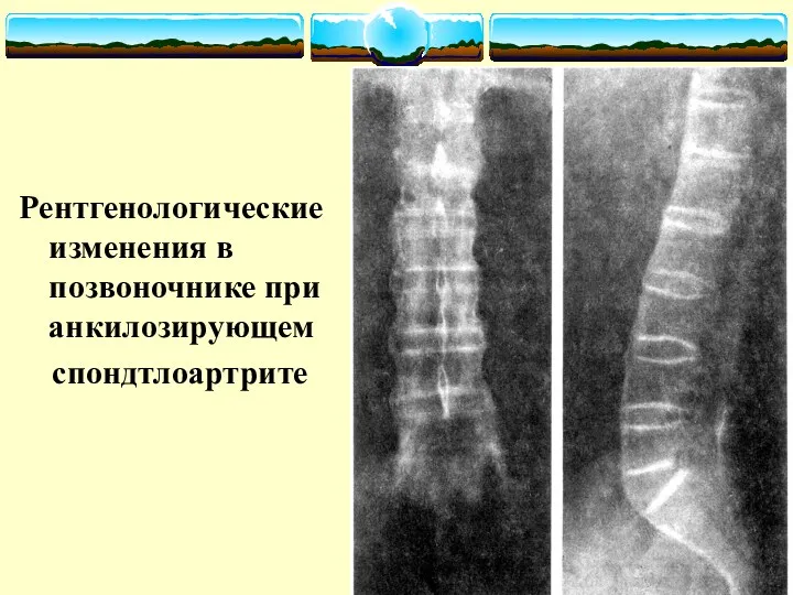 Рентгенологические изменения в позвоночнике при анкилозирующем спондтлоартрите
